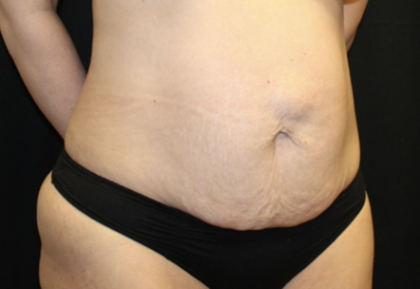 Tummy Tuck Before & After Patient #28671