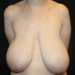 Breast Reduction Before & After Patient #28872