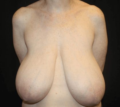 Breast Reduction Before & After Patient #28872