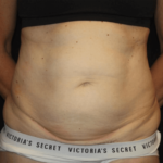 Tummy Tuck Before & After Patient #28861