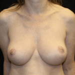 Breast Reduction Before & After Patient #28872