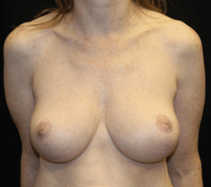 Breast Reduction Before & After Patient #28872