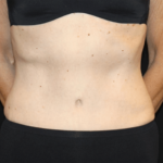 Tummy Tuck Before & After Patient #28861
