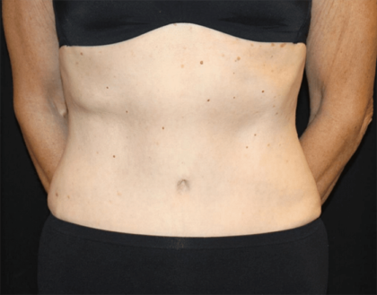 Tummy Tuck Before & After Patient #28861