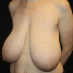 Breast Reduction Before & After Patient #28872