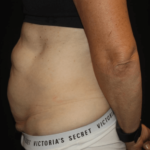 Tummy Tuck Before & After Patient #28861