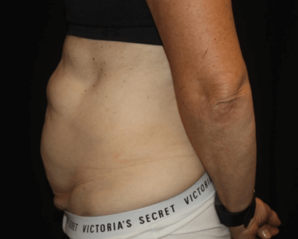 Tummy Tuck Before & After Patient #28861