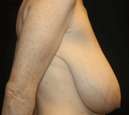 Breast Reduction Before & After Patient #28872