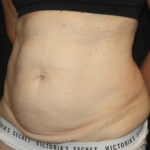 Tummy Tuck Before & After Patient #28861