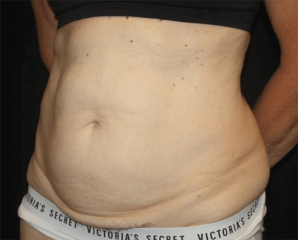 Tummy Tuck Before & After Patient #28861