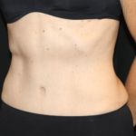 Tummy Tuck Before & After Patient #28861