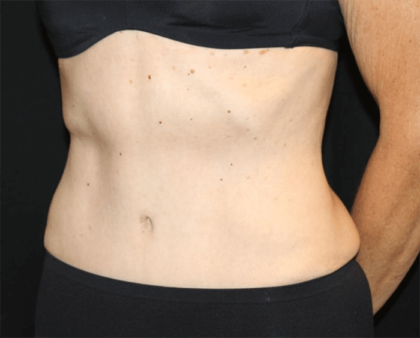 Tummy Tuck Before & After Patient #28861