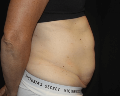 Tummy Tuck Before & After Patient #28861