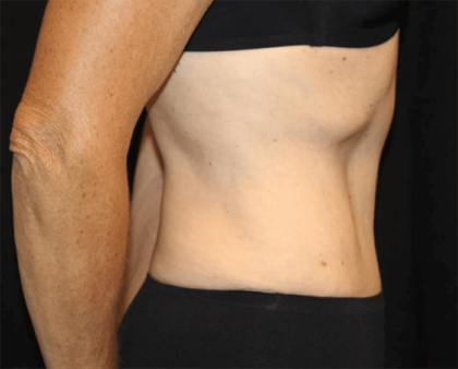 Tummy Tuck Before & After Patient #28861