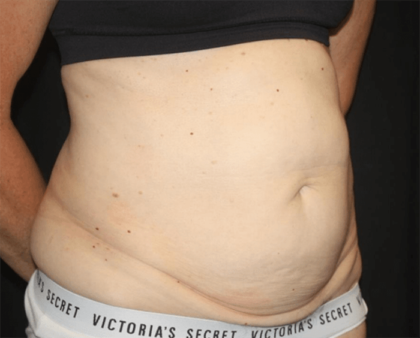 Tummy Tuck Before & After Patient #28861