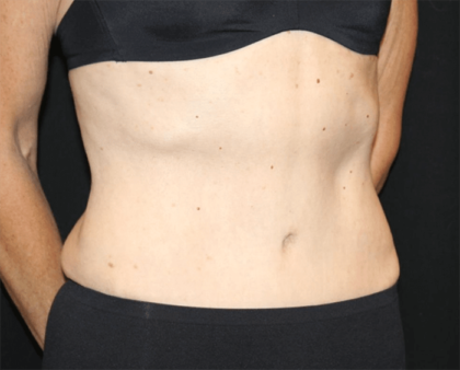 Tummy Tuck Before & After Patient #28861