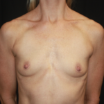 Breast Augmentation - Round Silicone Implants Before & After Patient #28892