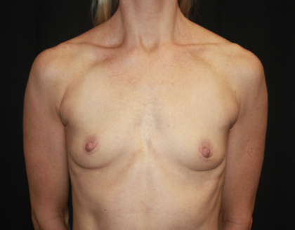 Breast Augmentation - Round Silicone Implants Before & After Patient #28892