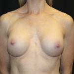 Breast Augmentation - Round Silicone Implants Before & After Patient #28892