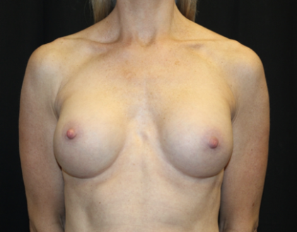 Breast Augmentation - Round Silicone Implants Before & After Patient #28892