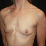 Breast Augmentation - Round Silicone Implants Before & After Patient #28892