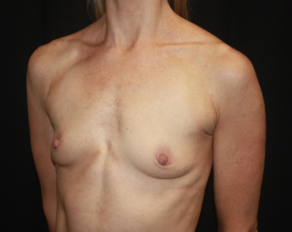 Breast Augmentation - Round Silicone Implants Before & After Patient #28892