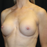 Breast Augmentation - Round Silicone Implants Before & After Patient #28892