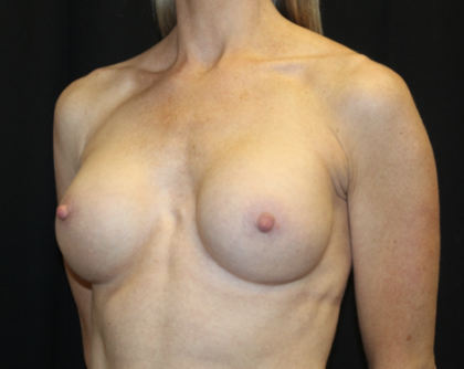 Breast Augmentation - Round Silicone Implants Before & After Patient #28892