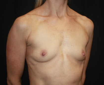 Breast Augmentation - Round Silicone Implants Before & After Patient #28892