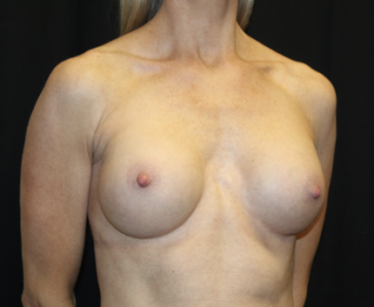 Breast Augmentation - Round Silicone Implants Before & After Patient #28892