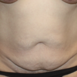 Tummy Tuck Before & After Patient #28881