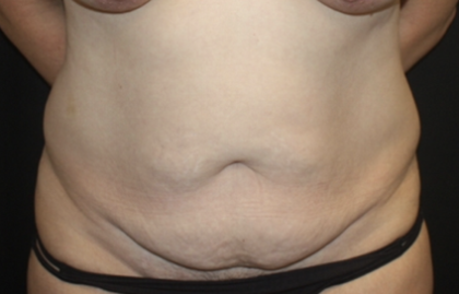 Tummy Tuck Before & After Patient #28881