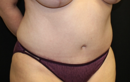 Tummy Tuck Before & After Patient #28881