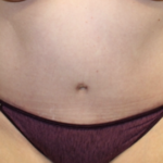 Tummy Tuck Before & After Patient #28881