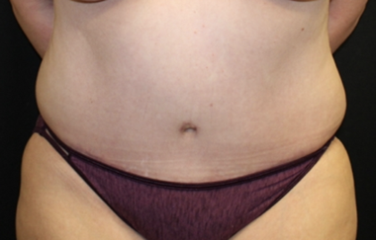 Tummy Tuck Before & After Patient #28881