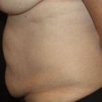 Tummy Tuck Before & After Patient #28881