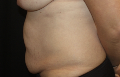 Tummy Tuck Before & After Patient #28881