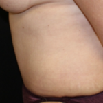 Tummy Tuck Before & After Patient #28881