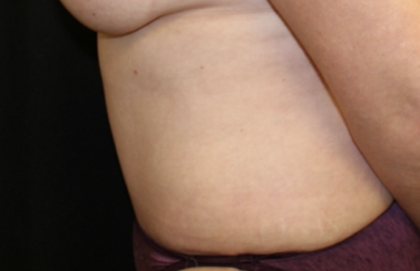 Tummy Tuck Before & After Patient #28881