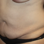 Tummy Tuck Before & After Patient #28881