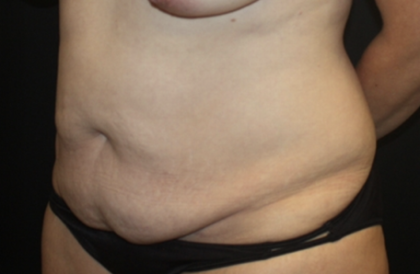 Tummy Tuck Before & After Patient #28881