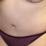 Tummy Tuck Before & After Patient #28881