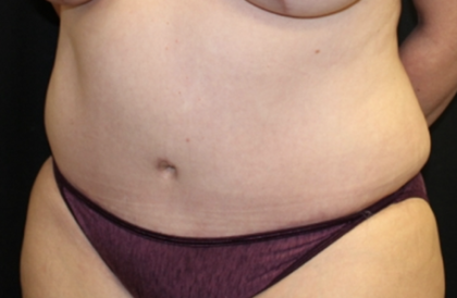 Tummy Tuck Before & After Patient #28881