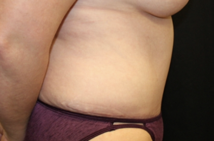 Tummy Tuck Before & After Patient #28881