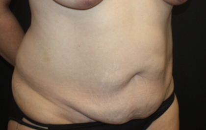 Tummy Tuck Before & After Patient #28881
