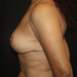 Breast Lift Before & After Patient #28934