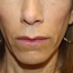 Injectable Fillers Before & After Patient #28962