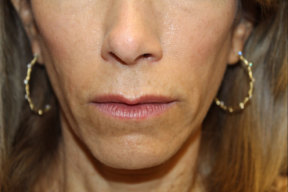 Injectable Fillers Before & After Patient #28962