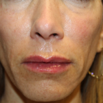 Injectable Fillers Before & After Patient #28962