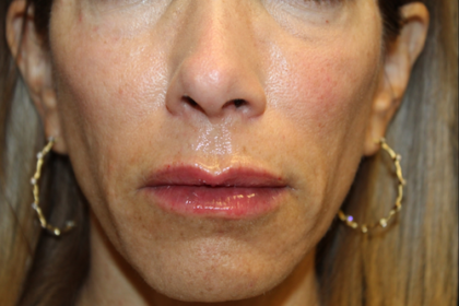 Injectable Fillers Before & After Patient #28962